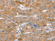 The image on the left is immunohistochemistry of paraffin-embedded Human liver cancer tissue using CSB-PA615896(STX2 Antibody) at dilution 1/40, on the right is treated with synthetic peptide. (Original magnification: ×200)