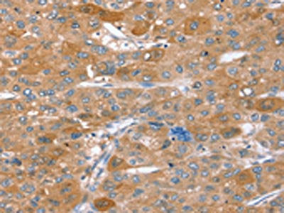 The image on the left is immunohistochemistry of paraffin-embedded Human liver cancer tissue using CSB-PA615896(STX2 Antibody) at dilution 1/40, on the right is treated with synthetic peptide. (Original magnification: ×200)
