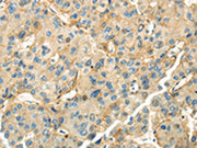 The image on the left is immunohistochemistry of paraffin-embedded Human liver cancer tissue using CSB-PA615999(CD70 Antibody) at dilution 1/35, on the right is treated with synthetic peptide. (Original magnification: ×200)