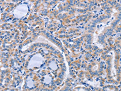 The image on the left is immunohistochemistry of paraffin-embedded Human thyroid cancer tissue using CSB-PA616030(CD36 Antibody) at dilution 1/60, on the right is treated with synthetic peptide. (Original magnification: ×200)