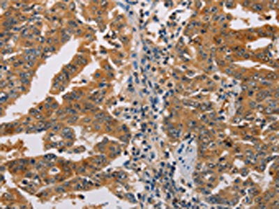 The image on the left is immunohistochemistry of paraffin-embedded Human gastic cancer tissue using CSB-PA616041(ACY1 Antibody) at dilution 1/25, on the right is treated with fusion protein. (Original magnification: ×200)