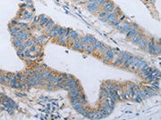 The image on the left is immunohistochemistry of paraffin-embedded Human colon cancer tissue using CSB-PA616184(BDNF Antibody) at dilution 1/20, on the right is treated with fusion protein. (Original magnification: ×200)