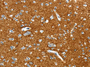 The image on the left is immunohistochemistry of paraffin-embedded Human brain tissue using CSB-PA616353(PTPN3 Antibody) at dilution 1/20, on the right is treated with fusion protein. (Original magnification: ×200)