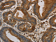 The image on the left is immunohistochemistry of paraffin-embedded Human colon cancer tissue using CSB-PA616691(KRT16 Antibody) at dilution 1/30, on the right is treated with synthetic peptide. (Original magnification: ×200)