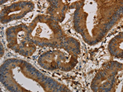 The image on the left is immunohistochemistry of paraffin-embedded Human colon cancer tissue using CSB-PA616691(KRT16 Antibody) at dilution 1/30, on the right is treated with synthetic peptide. (Original magnification: ×200)