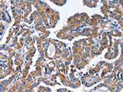 The image on the left is immunohistochemistry of paraffin-embedded Human thyroid cancer tissue using CSB-PA617064(IGSF10 Antibody) at dilution 1/50, on the right is treated with fusion protein. (Original magnification: ×200)