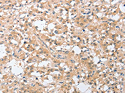 The image on the left is immunohistochemistry of paraffin-embedded Human thyroid cancer tissue using CSB-PA617106(SIGLEC9 Antibody) at dilution 1/30, on the right is treated with fusion protein. (Original magnification: ×200)