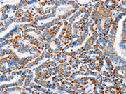 The image on the left is immunohistochemistry of paraffin-embedded Human thyroid cancer tissue using CSB-PA617446(ALG2 Antibody) at dilution 1/20, on the right is treated with fusion protein. (Original magnification: ×200)
