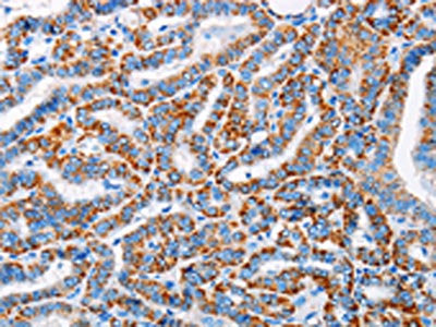 The image on the left is immunohistochemistry of paraffin-embedded Human thyroid cancer tissue using CSB-PA617446(ALG2 Antibody) at dilution 1/20, on the right is treated with fusion protein. (Original magnification: ×200)