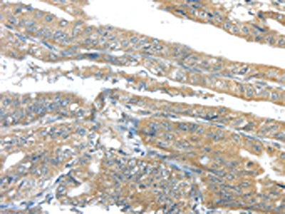 The image on the left is immunohistochemistry of paraffin-embedded Human esophagus cancer tissue using CSB-PA617669(AKT2 Antibody) at dilution 1/40, on the right is treated with synthetic peptide. (Original magnification: ×200)