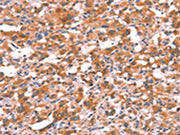 The image on the left is immunohistochemistry of paraffin-embedded Human thyroid cancer tissue using CSB-PA617734(GABRG2 Antibody) at dilution 1/20, on the right is treated with synthetic peptide. (Original magnification: ×200)