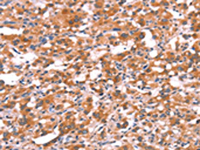 The image on the left is immunohistochemistry of paraffin-embedded Human thyroid cancer tissue using CSB-PA617734(GABRG2 Antibody) at dilution 1/20, on the right is treated with synthetic peptide. (Original magnification: ×200)