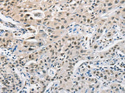 The image on the left is immunohistochemistry of paraffin-embedded Human lung cancer tissue using CSB-PA617763(CDC27 Antibody) at dilution 1/50, on the right is treated with fusion protein. (Original magnification: ×200)