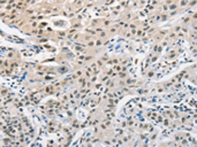 The image on the left is immunohistochemistry of paraffin-embedded Human lung cancer tissue using CSB-PA617763(CDC27 Antibody) at dilution 1/50, on the right is treated with fusion protein. (Original magnification: ×200)