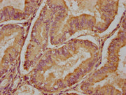 IHC image of CSB-PA617840LA01HU diluted at 1:100 and staining in paraffin-embedded human endometrial cancer performed on a Leica BondTM system. After dewaxing and hydration, antigen retrieval was mediated by high pressure in a citrate buffer (pH 6...