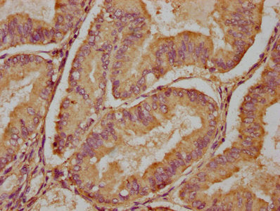 IHC image of CSB-PA617840LA01HU diluted at 1:100 and staining in paraffin-embedded human endometrial cancer performed on a Leica BondTM system. After dewaxing and hydration, antigen retrieval was mediated by high pressure in a citrate buffer (pH 6...