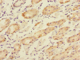 Immunohistochemistry of paraffin-embedded human gastric cancer using CSB-PA617901ESR1HU at dilution of 1:100