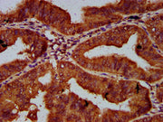 IHC image of CSB-PA617942LA01HU diluted at 1:600 and staining in paraffin-embedded human endometrial cancer performed on a Leica BondTM system. After dewaxing and hydration, antigen retrieval was mediated by high pressure in a citrate buffer (pH 6...