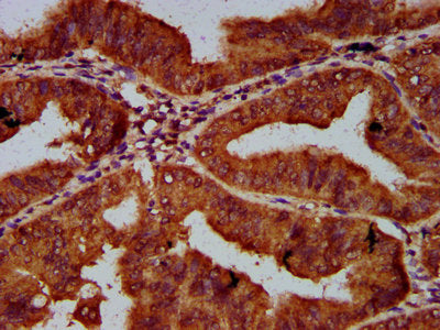 IHC image of CSB-PA617942LA01HU diluted at 1:600 and staining in paraffin-embedded human endometrial cancer performed on a Leica BondTM system. After dewaxing and hydration, antigen retrieval was mediated by high pressure in a citrate buffer (pH 6...