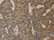 The image on the left is immunohistochemistry of paraffin-embedded Human liver cancer tissue using CSB-PA617990(DEGS1 Antibody) at dilution 1/40, on the right is treated with fusion protein. (Original magnification: ×200)