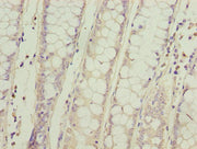 Immunohistochemistry of paraffin-embedded human colon cancer using CSB-PA617993LA01HU at dilution of 1:100