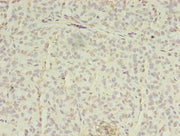 Immunohistochemistry of paraffin-embedded human breast cancer using CSB-PA618004LA01HU at dilution of 1:100