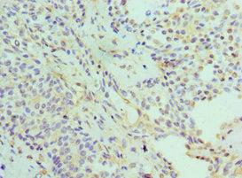 Immunohistochemistry of paraffin-embedded human breast cancer using CSB-PA618074ESR1HU at dilution of 1:100