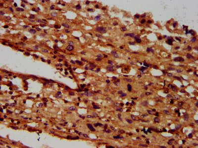 IHC image of CSB-PA618082LA01HU diluted at 1:600 and staining in paraffin-embedded human melanoma performed on a Leica BondTM system. After dewaxing and hydration, antigen retrieval was mediated by high pressure in a citrate buffer (pH 6.0). Secti...