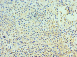 Immunohistochemistry of paraffin-embedded human breast cancer using CSB-PA618753ESR1HU at dilution of 1:100