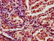 IHC image of CSB-PA618758LA01HU diluted at 1:400 and staining in paraffin-embedded human lung cancer performed on a Leica BondTM system. After dewaxing and hydration, antigen retrieval was mediated by high pressure in a citrate buffer (pH 6.0). Se...