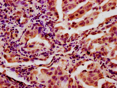 IHC image of CSB-PA618758LA01HU diluted at 1:400 and staining in paraffin-embedded human lung cancer performed on a Leica BondTM system. After dewaxing and hydration, antigen retrieval was mediated by high pressure in a citrate buffer (pH 6.0). Se...