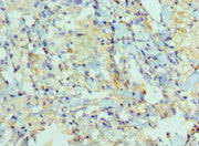 Immunohistochemistry of paraffin-embedded human lung cancer using CSB-PA618774ESR2HU at dilution of 1:100