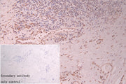 IHC image of CSB-PA618777ESR1HU diluted at 1:120 and staining in paraffin-embedded human gastric cancer performed on a Leica BondTM system. After dewaxing and hydration, antigen retrieval was mediated by high pressure in a citrate buffer (pH 6.0)....