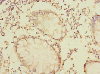 Immunohistochemistry of paraffin-embedded human colon cancer using CSB-PA618886LA01HU at dilution of 1:100