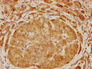 IHC image of CSB-PA618974LA01HU diluted at 1:400 and staining in paraffin-embedded human pancreatic cancer performed on a Leica BondTM system. After dewaxing and hydration, antigen retrieval was mediated by high pressure in a citrate buffer (pH 6....