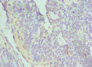 Immunohistochemistry of paraffin-embedded human endometrial cancer using CSB-PA618988ESR1HU at dilution of 1:100