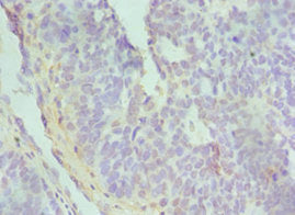 Immunohistochemistry of paraffin-embedded human endometrial cancer using CSB-PA618988ESR1HU at dilution of 1:100
