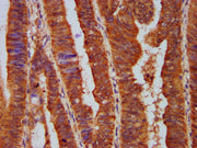 IHC image of CSB-PA619075LA01HU diluted at 1:500 and staining in paraffin-embedded human colon cancer performed on a Leica BondTM system. After dewaxing and hydration, antigen retrieval was mediated by high pressure in a citrate buffer (pH 6.0). S...