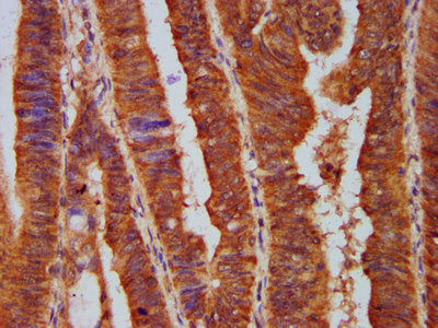 IHC image of CSB-PA619075LA01HU diluted at 1:500 and staining in paraffin-embedded human colon cancer performed on a Leica BondTM system. After dewaxing and hydration, antigen retrieval was mediated by high pressure in a citrate buffer (pH 6.0). S...