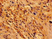 Immunohistochemistry of paraffin-embedded human cervical cancer using CSB-PA619636LA01HU at dilution of 1:100