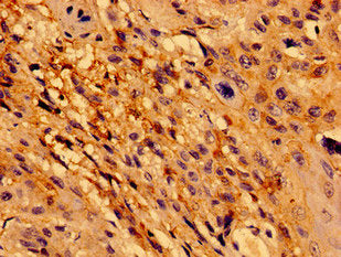 Immunohistochemistry of paraffin-embedded human cervical cancer using CSB-PA619636LA01HU at dilution of 1:100