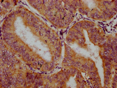 IHC image of CSB-PA619638LA01HU diluted at 1:300 and staining in paraffin-embedded human endometrial cancer performed on a Leica BondTM system. After dewaxing and hydration, antigen retrieval was mediated by high pressure in a citrate buffer (pH 6...