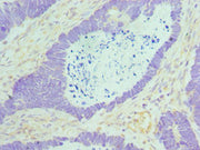 Immunohistochemistry of paraffin-embedded human ovarian cancer using CSB-PA619756ESR1HU at dilution of 1:100