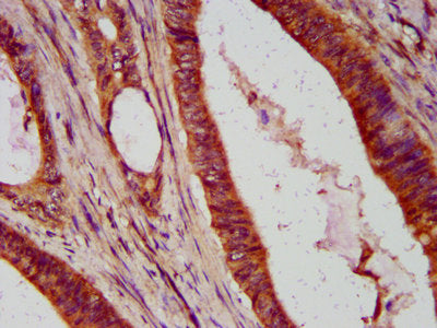 IHC image of CSB-PA619756LA01HU diluted at 1:400 and staining in paraffin-embedded human colon cancer performed on a Leica BondTM system. After dewaxing and hydration, antigen retrieval was mediated by high pressure in a citrate buffer (pH 6.0). S...