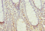 Immunohistochemistry of paraffin-embedded human colon cancer using CSB-PA619761ESR2HU at dilution of 1:100