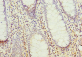 Immunohistochemistry of paraffin-embedded human colon cancer using CSB-PA619761ESR2HU at dilution of 1:100