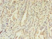 Immunohistochemistry of paraffin-embedded human lung cancer using CSB-PA619871LA01HU at dilution of 1:100