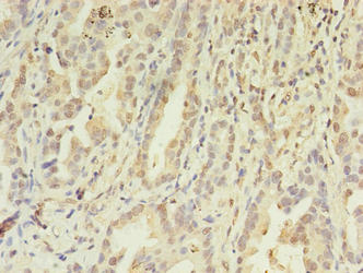 Immunohistochemistry of paraffin-embedded human lung cancer using CSB-PA619871LA01HU at dilution of 1:100