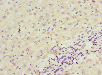 Immunohistochemistry of paraffin-embedded human liver cancer using CSB-PA619892ESR2HU at dilution of 1:100