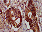 IHC image of CSB-PA619965LA01HU diluted at 1:300 and staining in paraffin-embedded human colon cancer performed on a Leica BondTM system. After dewaxing and hydration, antigen retrieval was mediated by high pressure in a citrate buffer (pH 6.0). S...